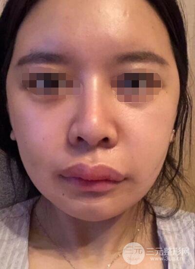 下頜角整形案例術(shù)后2周