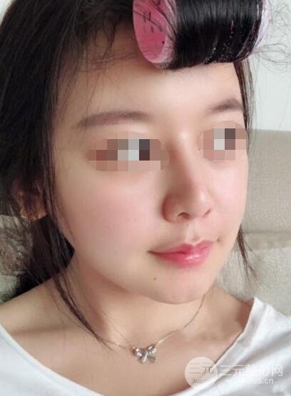 下頜角整形案例術(shù)后5周