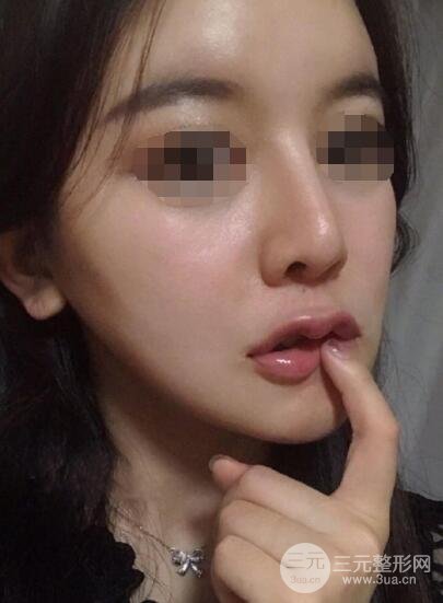 下頜角整形案例術(shù)后12周