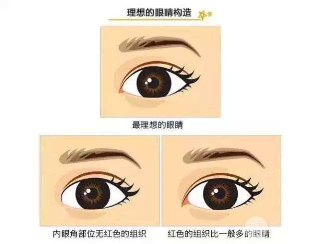 割雙眼皮開眼角手術(shù)注意事項