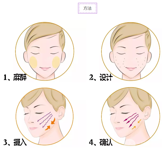 面部下垂怎么辦 埋線除皺