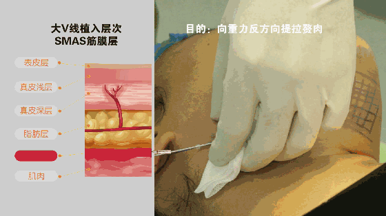埋線除皺手術(shù)過程