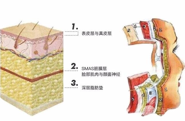 埋線除皺提升面部下垂