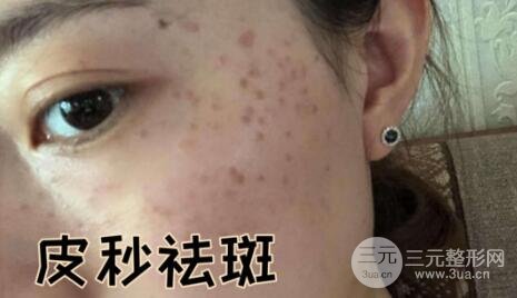 蜂巢激光祛斑案例術前