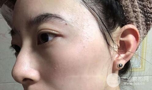 蜂巢激光祛斑案例術后2個月