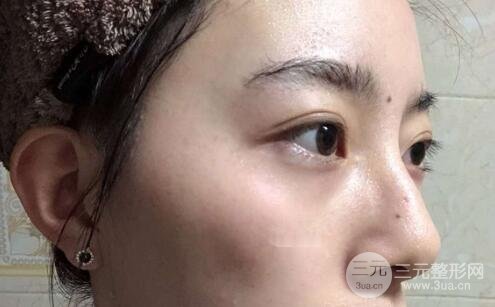 蜂巢激光祛斑案例術后4個月