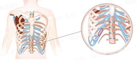 肋軟骨隆鼻的優(yōu)點(diǎn)