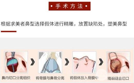 硅膠假體隆鼻手術(shù)