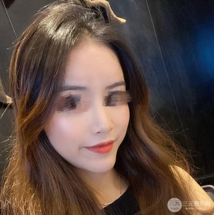 硅膠假體隆鼻果圖