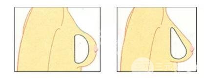 上海九院隆胸大概多少錢?幾有做呢?