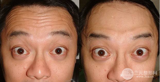 抬頭紋怎么去除