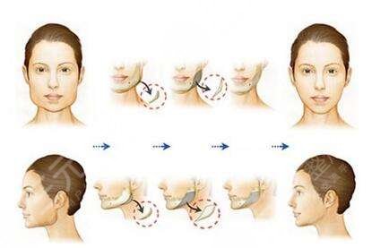 磨骨怎樣變瓜子臉