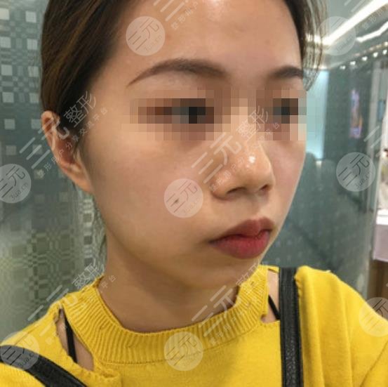 上海九院整形醫(yī)院墊下巴案例