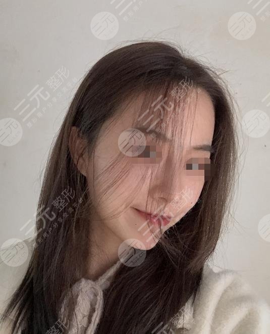 上海九院整形醫(yī)院墊下巴案例