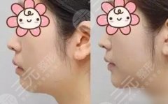 隆下巴的價(jià)格，直接解決下巴后縮、短小