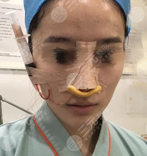 塌鼻子的救星 肋軟骨隆鼻