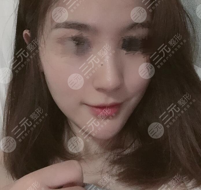 隆鼻術后果圖