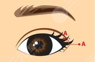 睜眼恢復時間也與個人體質和術后護理有關