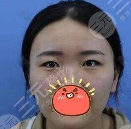 開外眼角案例前