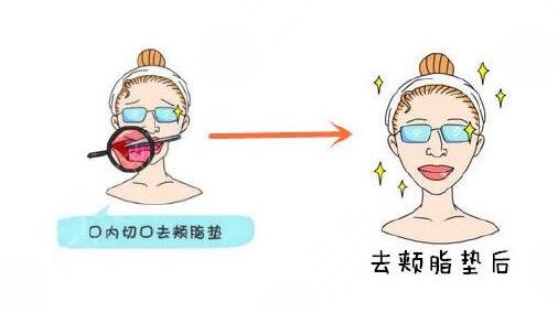 去頰脂墊手術(shù)簡(jiǎn)介