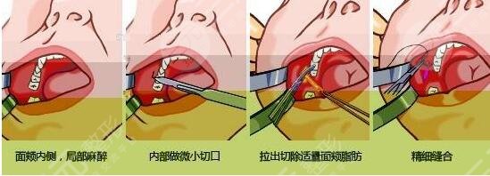 去頰脂墊手術(shù)簡(jiǎn)介