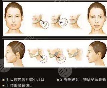 去頰脂墊手術(shù)術(shù)后護(hù)理