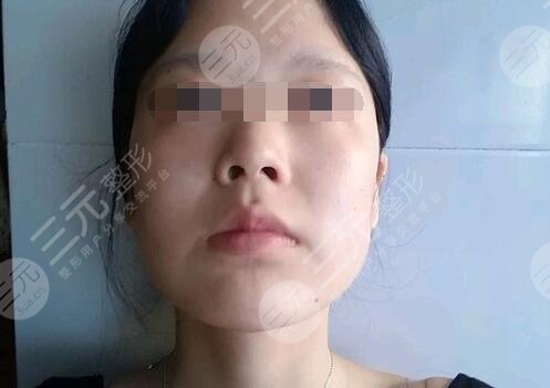 去頰脂墊手術(shù)案例前