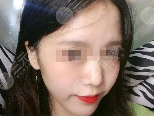 去頰脂墊手術(shù)案例后