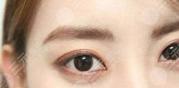 上瞼下垂手術(shù)有風(fēng)險(xiǎn)嗎？如何避免風(fēng)險(xiǎn)呢？