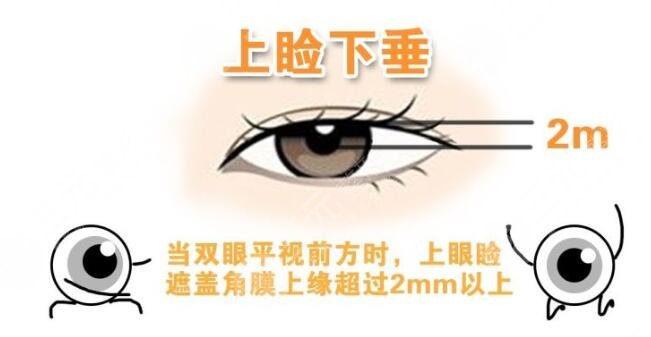 上瞼下垂手術(shù)有風(fēng)險(xiǎn)嗎?如何避免風(fēng)險(xiǎn)呢?