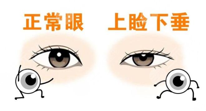 上瞼下垂手術(shù)有風(fēng)險(xiǎn)嗎?如何避免風(fēng)險(xiǎn)呢?