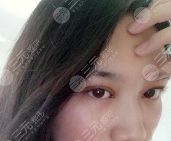 上瞼下垂矯正案例后