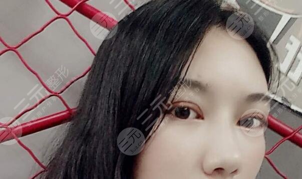 上瞼下垂矯正案例后4個(gè)月