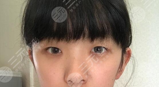 上瞼松弛矯正術(shù)案例前