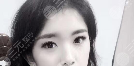 上瞼松弛矯正術(shù)案例后