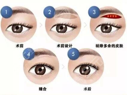 切眉術會留下傷疤嗎?