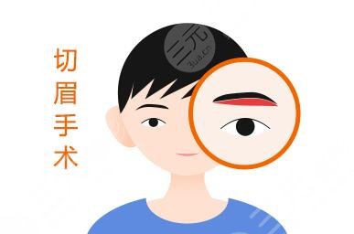 切眉術進程介紹