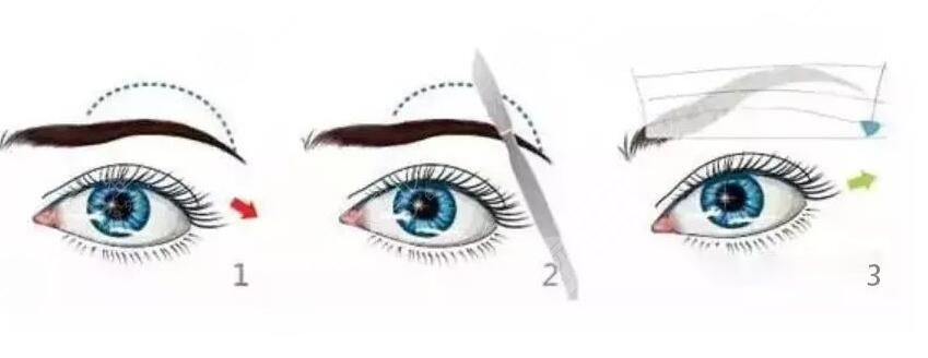 切眉術后的護理注意事項