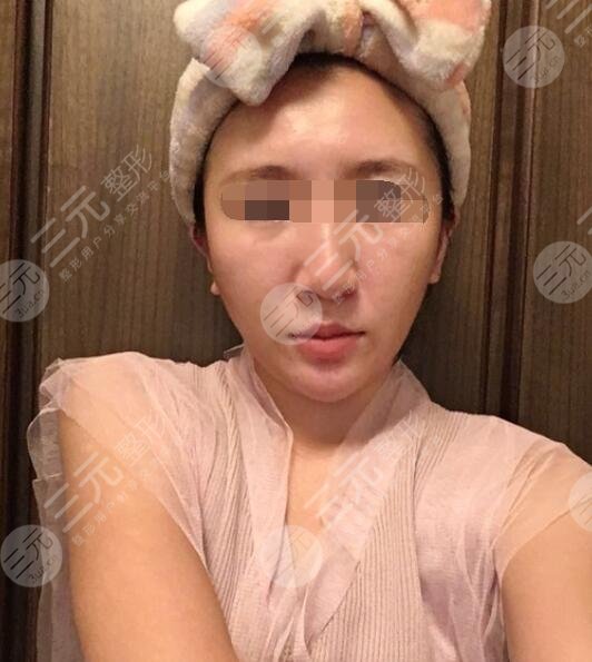 注射美白真人果前