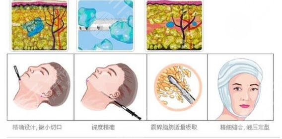 光纖溶脂瘦臉術后護理