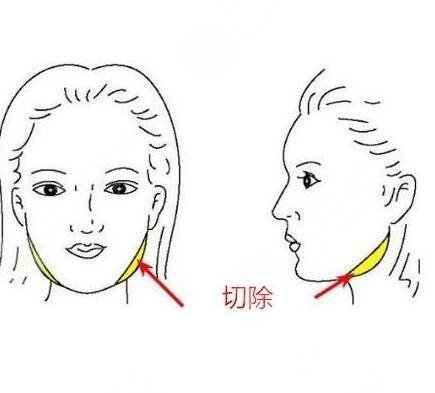 咬肌切除手術(shù)風(fēng)險(xiǎn)大么