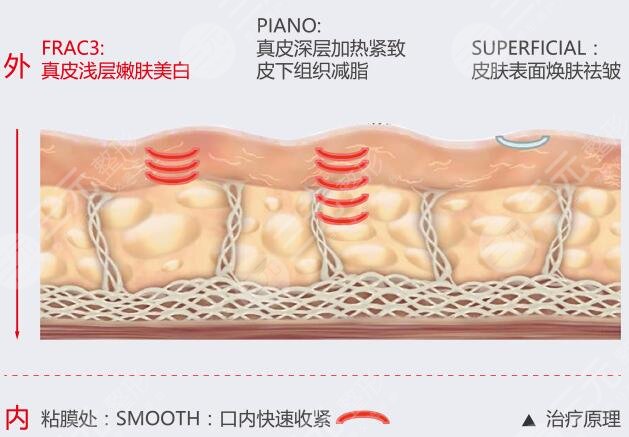 什么是火鳳凰溶脂