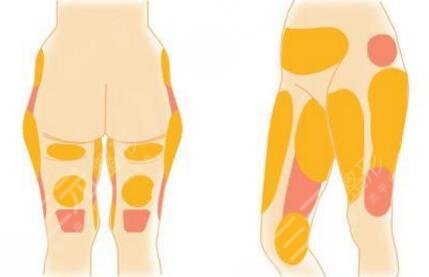火鳳凰溶脂降低風(fēng)險嗎