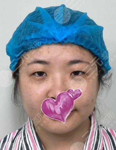 武漢協和醫(yī)院割雙眼皮果圖