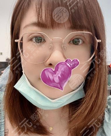 武漢協和醫(yī)院割雙眼皮果圖