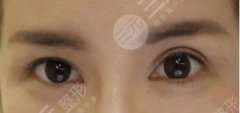 雙眼皮埋線修復(fù)過程圖|埋線雙眼皮失敗的八種圖片