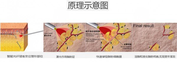 光纖溶脂瘦臉的優(yōu)勢