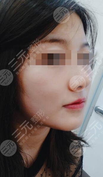 面部溶脂果后2周