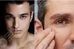 黑眼圈怎么形成的？怎么才能快速消除微創(chuàng)微創(chuàng)？