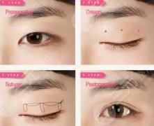 拉雙眼皮手術(shù)全過程，手術(shù)方法|術(shù)后護(hù)理大全